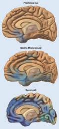 Alzheimer's Disease, Spreads through the Brain | Illustratio… | Flickr
