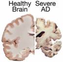 Healthy Brain and Severe AD Brain | Comparison of a healthy … | Flickr