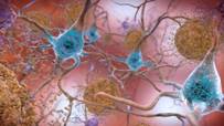 Beta-Amyloid Plaques and Tau in the Brain | In the Alzheimer… | Flickr